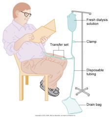 --Involves siliconized rubber catheter placed into abdominal cavity for infusion of dialysate

Types:
--Continuous ambulatory (CAPD)
--Automated
--Intermittent
--Continuous-cycle
--Peritoneal Dialysis Exchange
--Continuous Ambulatory Peritoneal Di