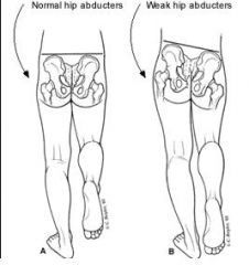 Indication: Gluteus Medius (hip abductors) weakness
Pt stands on one leg, then the other
Normal: Hip abductors are normal on weight-bearing side, opposite hip should rise. 
+: Weak hip abductors cause opposite hip to drop (the non-weighbearing side). L