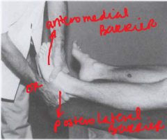 Indication: Posterolateral/Anteromedial Glide of Talus Restricted 
Pt supine. 
Dr. grasps calcaneus, takes calcaneus into barrier. Traction of calcaneus is applied to take up slack. TRACTION TUG through barrier applied at subtalar joint.