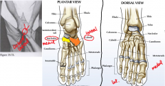 Pt prone. Dysfunctional leg off side of table. 
Dr. grasps pt's foot with both hands and places thumb in a "V" shape over the plantar surface of the navicular (medial) or cuboid (lateral, 5th MT) -- whichever is dropped.
Dr exerts DOWNWARD THRUST throug