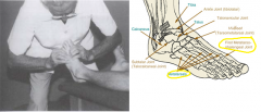 Dx: Restriction of joint play at metatarsal heads
Pt supine
Dr's medial hand grasps shaft of 2nd metatarsal, while lateral hand grasps shaft of 3rd metatarsal. While stabilizing second metatarsal, Dr.'s lateral hand dorsal and plantar moves the metatars