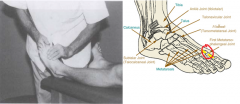 Dx: Restriction at MTP/Interphalangeal joints
Pt supine. 
Dr. stabilizes proximal bone with thumb and fingers (first metatarsal). Dr. grasps distal bone (proximal phalanx of first toe). 
Flex-Extend, Anterior-Posterior Glide, Medial-Lateral Rotation, M