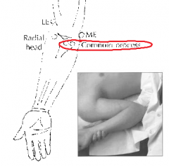 Coronoid process	Pt supine
Pull forearm out to side a bit, with palm facing forward, then marked flexion 
F-Ab