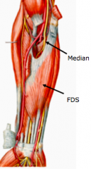 Flexor Digitorum Superficialis (FDS)
•	Proximal attachments – two heads
(i)	Humeroulnar head:  Medial epicondyle of humerus and coronoid process of ulna
(ii)	Radial head:  superior half of anterior border of radius
•	Distal attachments
(i)	Bodies of 