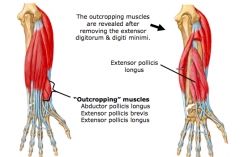 Extensor pollicis longus
•	Proximal attachments
(i)	Posterior surface of the middle 1/3 of the ulna and the interosseous membrane
•	Distal attachments
(i)	Base of distal phalanx of thumb
•	PIN (posterior interosseous nerve) – branch of radial nerve

