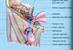 Femoral Sheath, Ring and Canal (fig 5.16-5.18…p. 542-544)
a.	Provides pathway for femoral artery/vein and lymph nodes to pass under the inguinal ligament
b.	Femoral Sheath 
•	funnel-shaped fascial tube that is divided into three compartments
(i)	Later