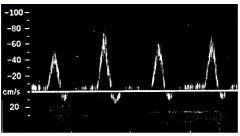 1. Triphasic waveform
2. Peak Systolic Volume of 100 cm/sec
3. No spectral broadening
4. Normal proximal and distal
5. No visible plaque