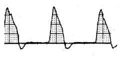 Name this waveform. 
Abnormal or Normal