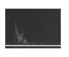Name this type of waveform
Normal or abnormal?
Pre or Post Stenosis?