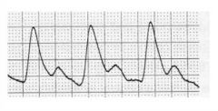 Is this a Normal or Abnormal post exercise waveform