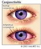 Diffuse redness of conjunctiva 
discharge (pus)
mild pain/discomfort
clear cornea

note: conjunctival injection (reddening) is more superficial therefore more red than corneal injection (deeper/less red)