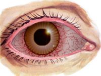 Ciliary injection (injection = reddening) 
decreased vision
severe pain 
pus is trapped within eye but not leaking as in Conjunctivitis

(infection is deeper therefore pain is greater than conjunctival infections)