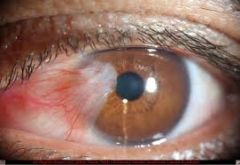 Thicking of bulbar conjunctiva which grows over the outer surface of the cornea

Note:
bulbar conjunctiva = covers eye
palpebral conjunctiva = covers eyelid