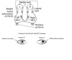 CNVI paralysis
(abducen's nerve)
