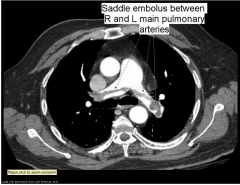 - Used to dx PE
- Performed by injecting technetium labeled macroaggregated albumin particles intravenously - these 'stick' in the smaller pulmonary capillaries and remain there for several hours until phagocytosed. Distribution of the particles provides