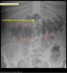 - "Thumbprinting" sign
- When colon wall thickened, protrudes into bowel. 
- IBD