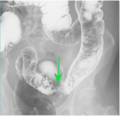 Seen in patients with colon carcinoma