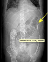Inflammation from the pancreatitis causes inflammation and spasm of the adjacent bowel and may result in a partial pseudoobstruction at the splenic flexure.