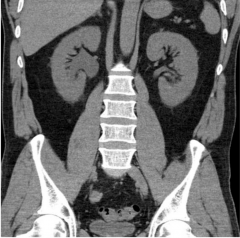 Right hydronephrosis, renal enlargement, and perinephric stranding.