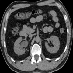 Right hydronephrosis, renal enlargement, and perinephric stranding.