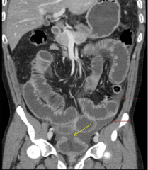 Yellow arrow shows rupture. Red arrows shows where urine leaked into abdomen.