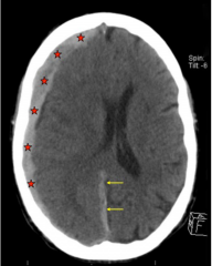 - Occur b/w dura and arachnoid.
- Due to tearing of bridging cerebral veins
- Crescent shaped
- Do NOT cross flax