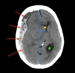 - Red arrows point to subdural collection
- Yellow star shows compressed RIGHT lateral ventricle
- Blue line is midline and shift from
- Green star shows dilated occipital horn of LEFT lateral ventricle