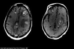 - Multiple lesions
- Abundant edema
- Hyperintense center w/ T2 imaging
- Involvement of deep gray matter (Basal Ganglia)