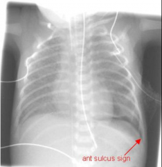 - Occurs in pneumothorax
- When lying supine, air goes to highest part in thorax --> deep sulcus.
