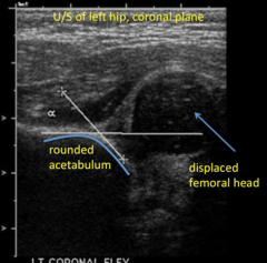 - Shallow acetabular development
- Predisposition to Subluxation and dislocation of hip
- Ultrasound is best in 2 month olds because not enough calcifications yet for radiograph.