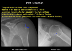 - During dislocation, happens when humeral head hits the glenoid