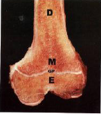 What is diagrammed on this distal femur?