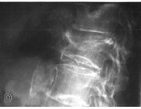 Radiological findings in osteoporosis - spine