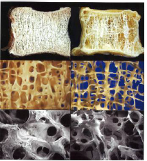 Which side is normal and which side has osteoporosis?