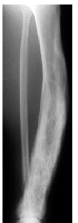 What bone caused the tibia, here, to be bowed and the affected area is enlarged and sclerotic?