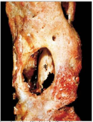 See image - dead bone in the middle of healing osteomyelitis

The bone in the center of the inflammation
undergoes necrosis (characterized by loss of nuclei), forming a sequestrum