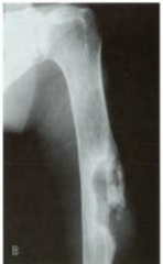 Squamous cell carcinoma as a result of chronic osteomyelitis