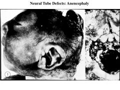 Neural tube defect; failure of development of brain due to lack of closure at the ANTERIOR neuropore-->complete absence of structures above the diencephalon; complete replacement of brain with fibrous tissue; 1:1000; likely environmental etiology

*note