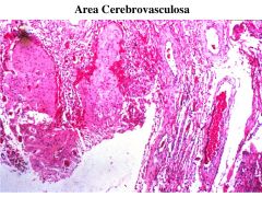 cerebrovasculosa: lots of blood vessels and fibrous tissues where brain tissue should be