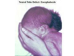 neural tube defect; Outpouching of epithelium-enclosed brain tissue through a cranial defect 

In the East, mostly anterior encephalocele, in the West, mostly occipital encephalocele

(think: ENcephalocele, ENclosure of brain tissue)