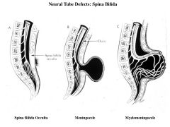 neural tube defect; Failure of closure at the POSTERIOR neuropore
3 subtypes: spinal bifida occulta, meningocele, meningomyelocele, (rachischisis, craniorachisichisis totalis)