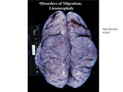 A migration disorder; happens early in development; complete absence of gyri in the brain--> smooth contours
(associated with Miller-Dieker syndrome)