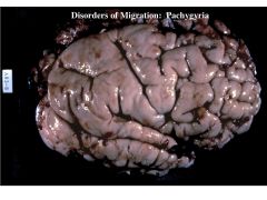 A migration disorders; occurs when migration is already underway; results in flattened and enlargened ("pachy") gyri; 4 cortical layers instead of 6