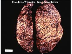 A migration disorder; occurs late in migration (after when pachygyria would occur); four layer cerebral cortex with small gyri are seen