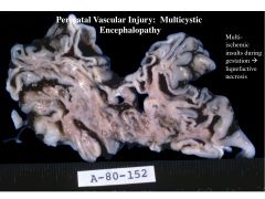 perinatal vascular injury; Accumulation of small infarcts because of multiple ischemic insults in developing brain--> liquefactive necrosis-->cysts and holes throughout brain parenchyma