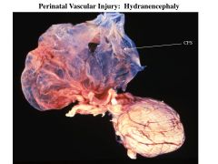 perinatal vascular injury; Caused by a complete occlusion of carotid arteries (usually internal). No brain tissue grows because there is no blood supply--> where the brain would be is a watery sac