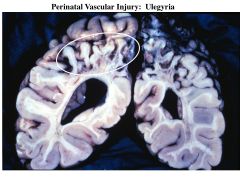 perinatal vascular injury; thinned out and gliotic gyria
