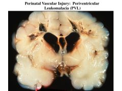 perinatal vascular injury; atrophy and necrosis of white matter in and around ventricles; hypothesized to be caused by impaired perfusion at boundary zone between ventriculopetal and ventriculofugal arteries were metabolic requirements are high (cause of 