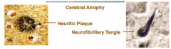 - patients have abundant neuritic plaques and neurofibrillary tangles
- loss of cholinergic neurons in nucleus basalis of Meynert, which are the origin of cholinergic supply for the cortex

-the plaques consist of neurites (axons or dendrites), astrocy