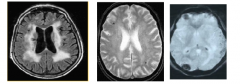 LEFT: Flare
     -white is abnormal; see lacunar infarcts as a sign of microvascular disease

MIDDLE: micro hemorrhages
     -black dots in the central image; this is a sign of amyloid deposition in amyloid angiography in blood vessels
     -amyloid 